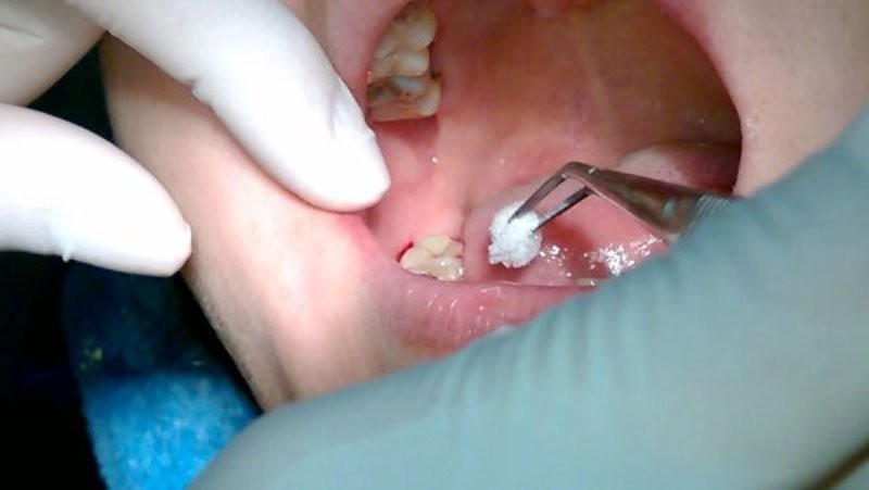 Hướng dẫn chăm sóc sau khi nhổ răng khôn 2 huong dan cham soc sau khi nho rang khon 2