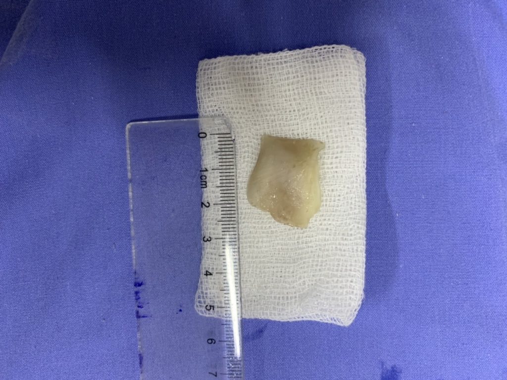 Cấp cứu thành công bệnh nhân hóc xương cá 3×2 cm