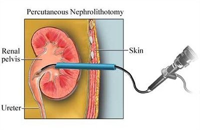 Tán sỏi thận qua da ở đâu tốt với chi phí hợp lý?