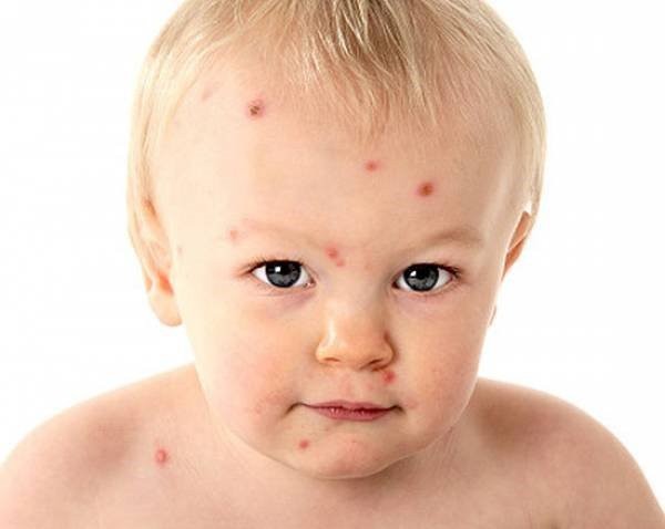 Bệnh thủy đậu mùa hè: Nguyên nhân, triệu chứng và các điều trị hiệu quả