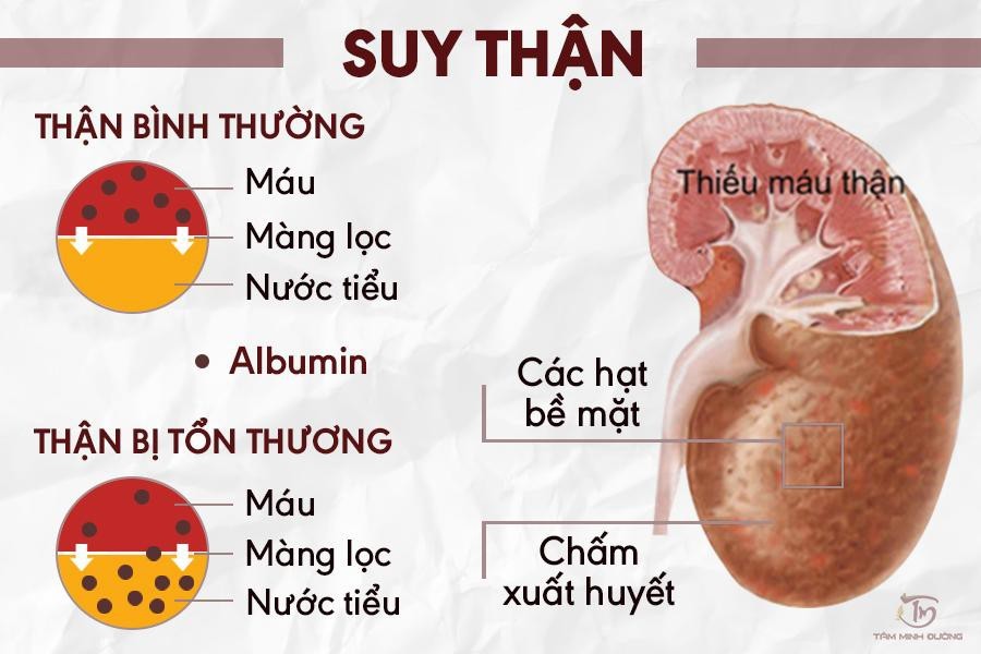 Suy thận cấp thường xảy ra khi nào? Triệu chứng và nguyên nhân gây suy thận cấp