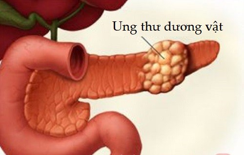 ung thu duong vat