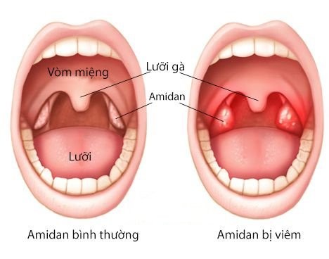 amidal 1