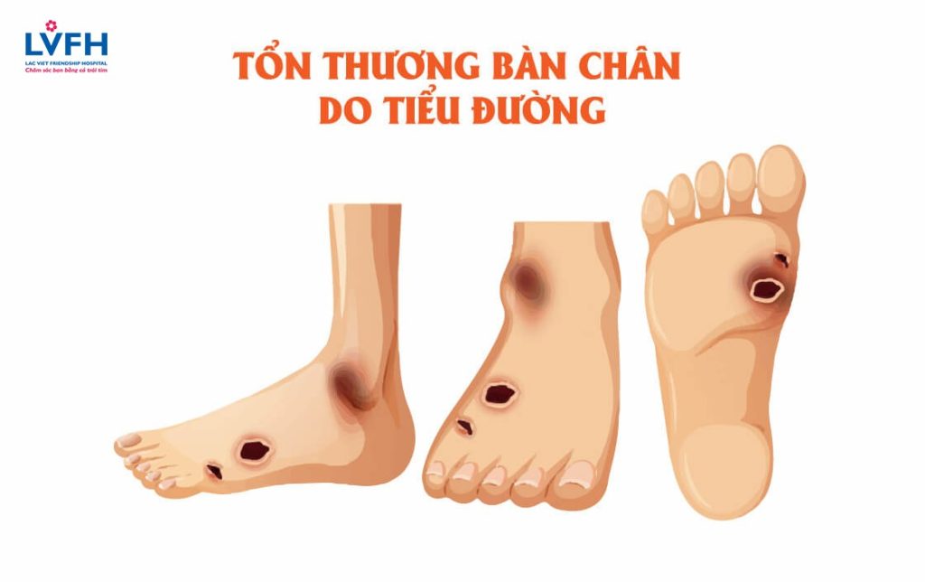BỆNH TIỂU ĐƯỜNG ẢNH HƯỞNG ĐẾN BÀN CHÂN NHƯ THẾ NÀO?