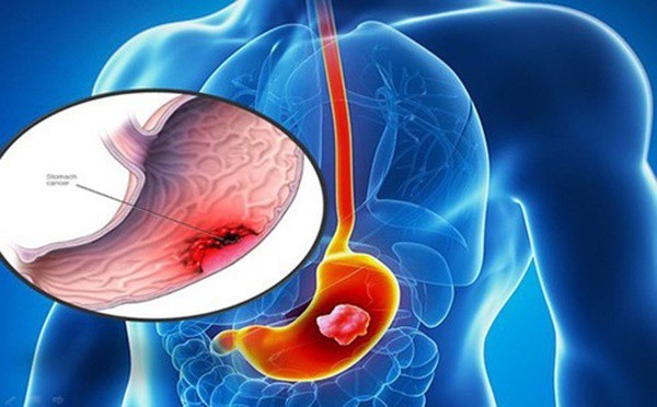 ung thư dạ dày và những điều cần biết