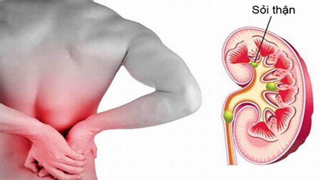 PHẪU THUẬT LẤY SỎI THẬN CHO BỆNH NHÂN TỪ PHÚ THỌ