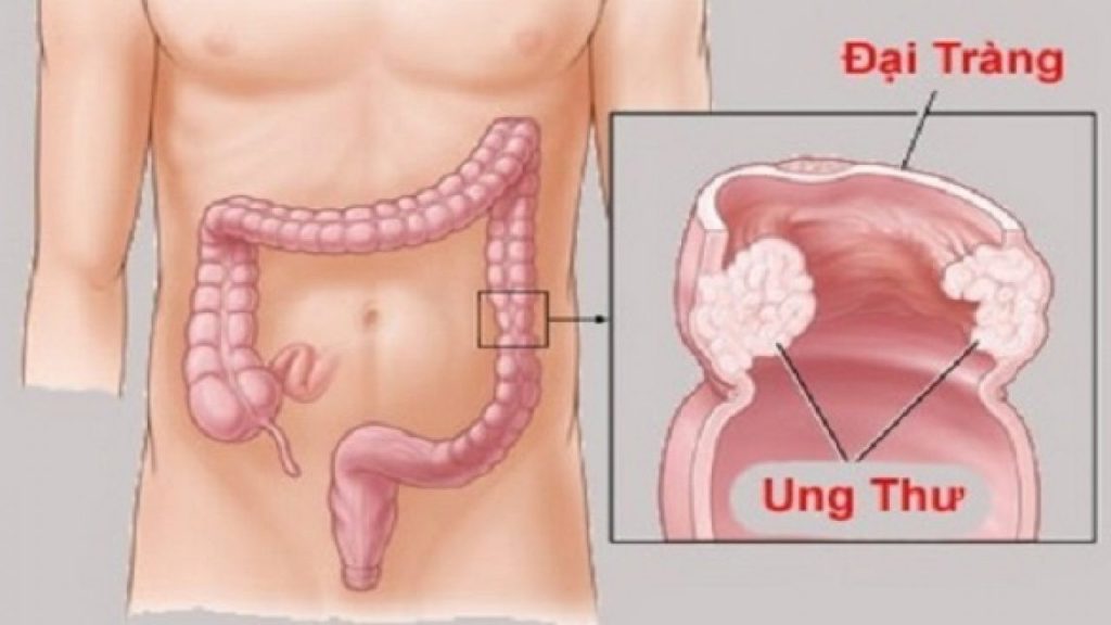 Giảm đau hiệu quả cho bệnh nhân ung thư đại tràng di căn xương, phổi tưởng đã hết cách điều trị