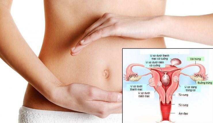 U xơ tử cung – triệu chứng và các phương pháp điều trị