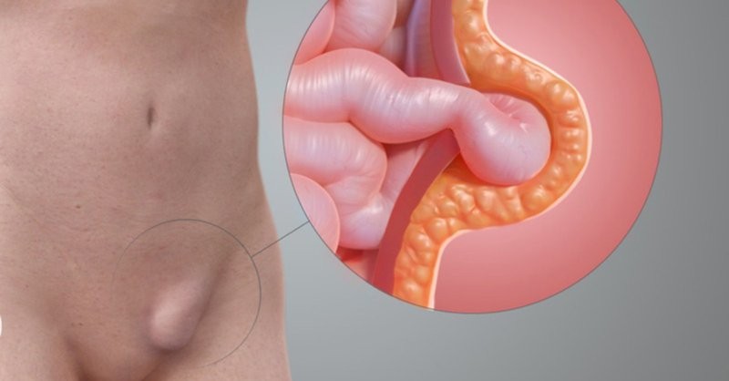 Thoát vị bẹn nghẹt: mức độ nguy hiểm và phương pháp điều trị