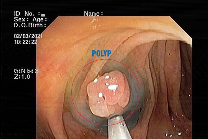 Bất ngờ phát hiện bị đa polyp sau 1 năm kiểm tra nội soi đại tràng