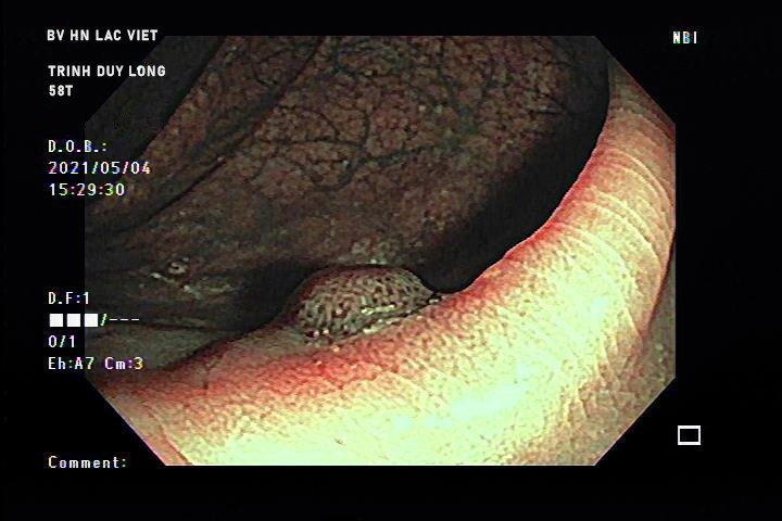 Anh Polyp