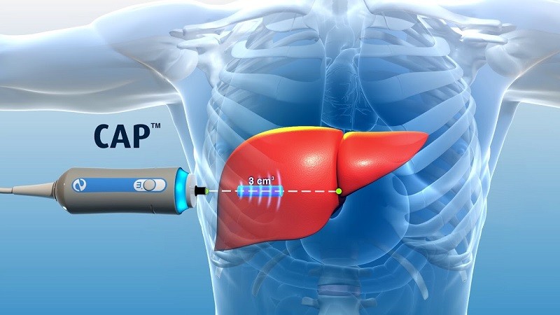 Công nghệ siêu âm xơ gan mới Fibroscan