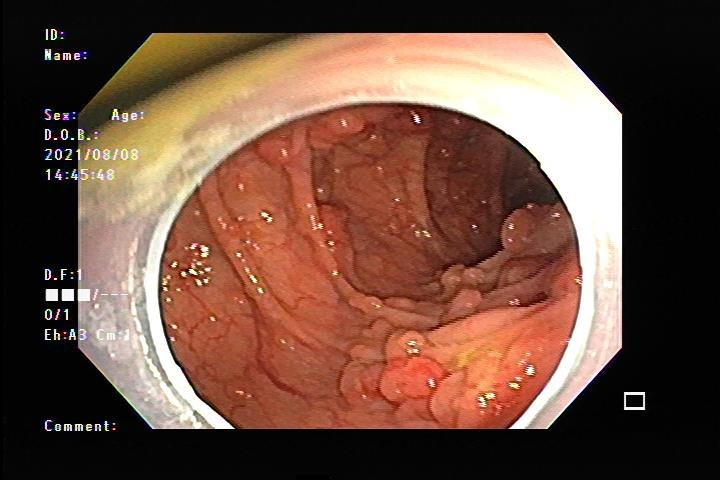 Hàng trăm polyp rải rác khắp đại tràng