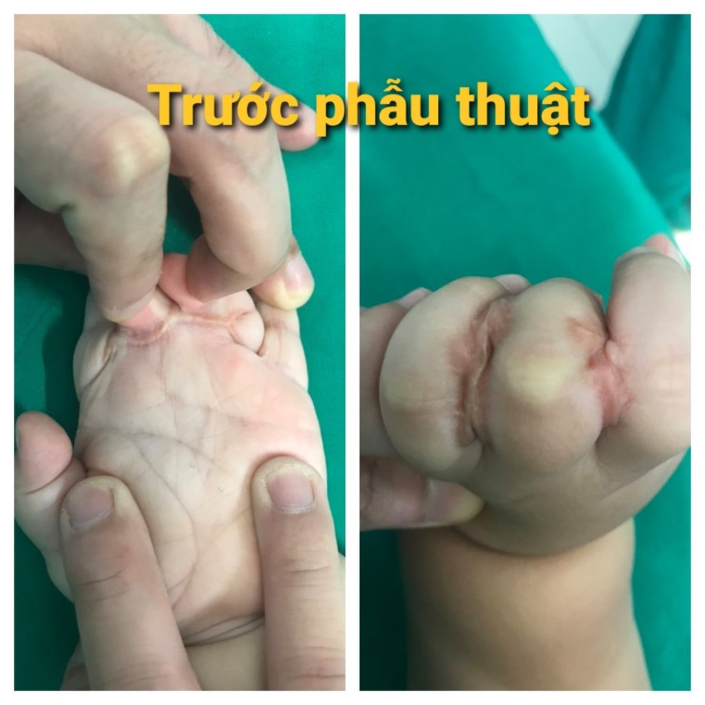 Quá trình hồi phục của em bé 2 tuổi bị dính khớp ngón tay do bỏng