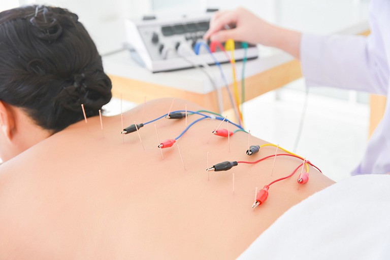 Điện châm điều trị giảm đau
