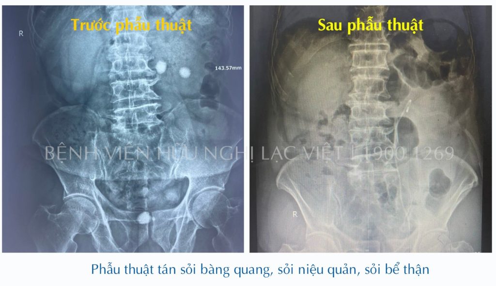 Điều trị sỏi bằng phương pháp phẫu thuật tán sỏi ngược dòng  kết hợp nội soi tán sỏi qua da