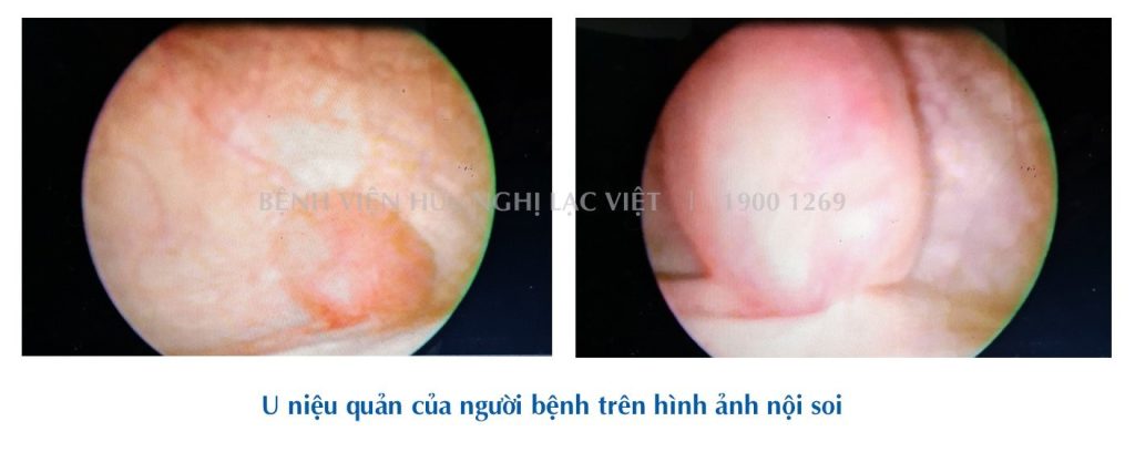 Đi khám sức khỏe định kì, người phụ nữ phát hiện mắc loại u ít gặp