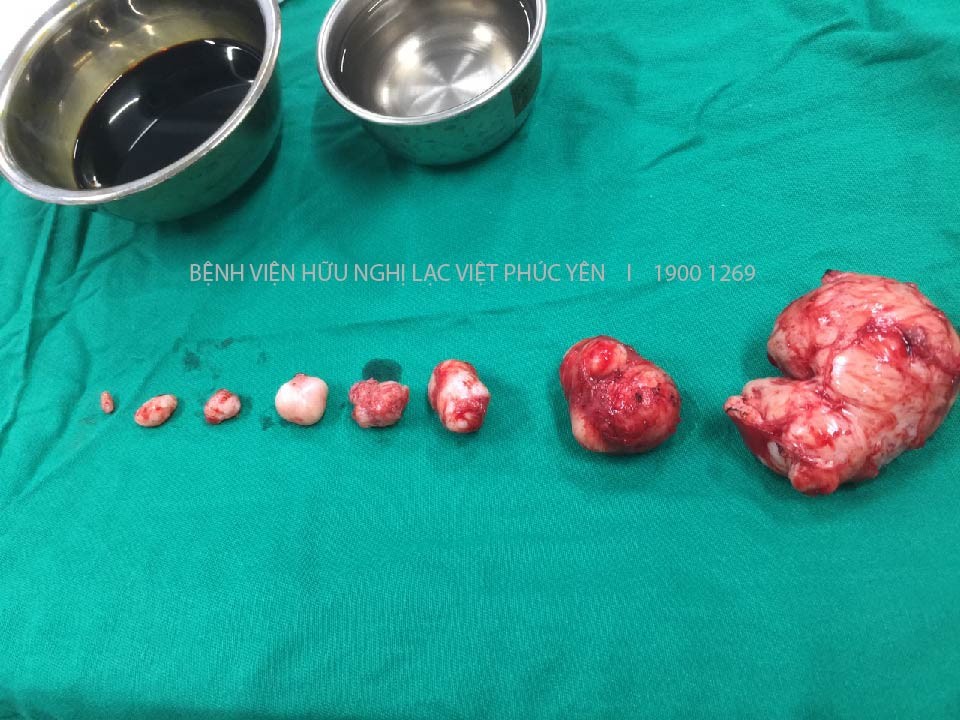Đau bụng đi khám người phụ nữ phát hiện 8 khối u xơ trong tử cung