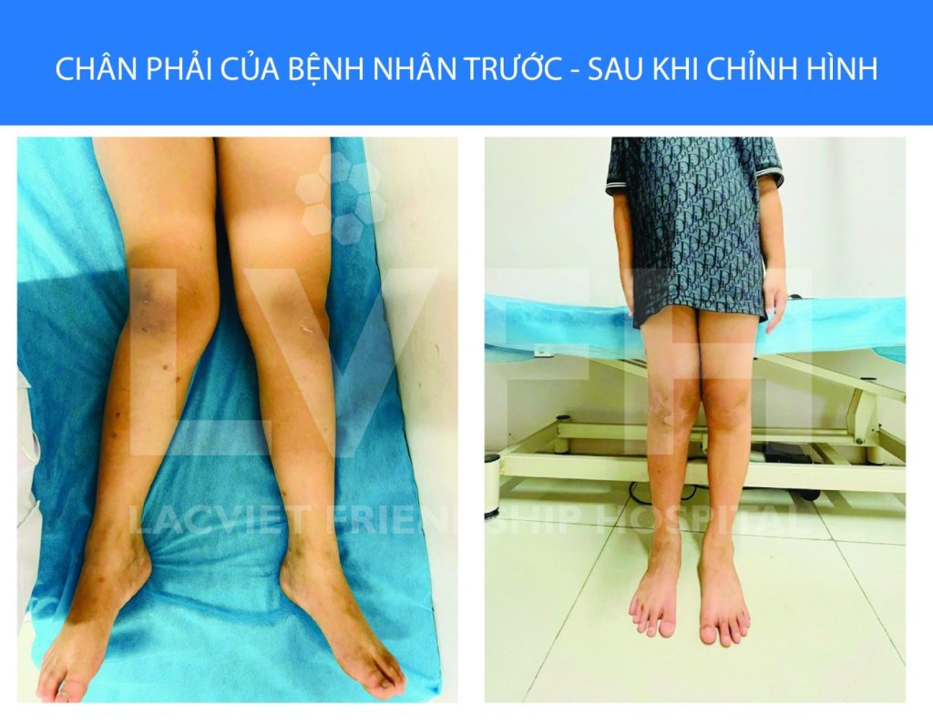 Phẫu thuật kéo thẳng chân cong vẹo cho bé 11 tuổi