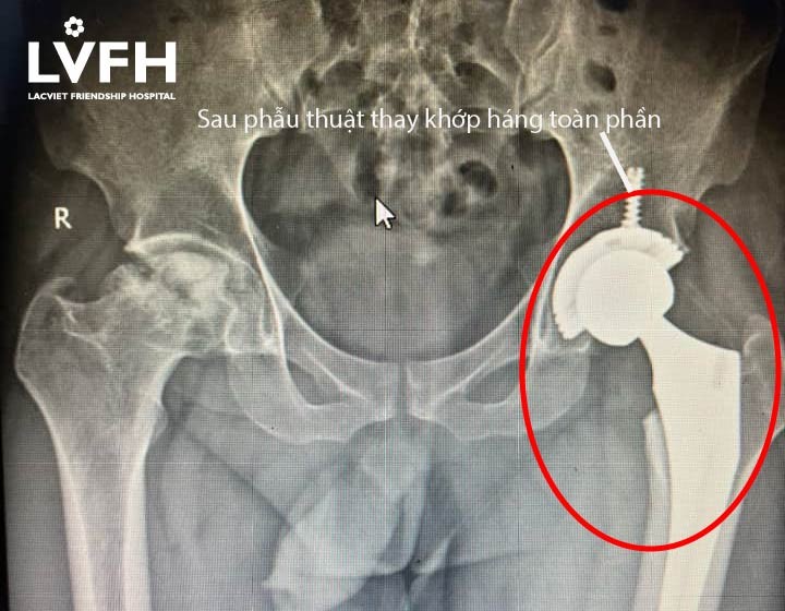 Nguy cơ mắc bệnh hoại tử vô khuẩn chỏm xương đùi ở người trẻ 2 Sau Pt Thử 01 01
