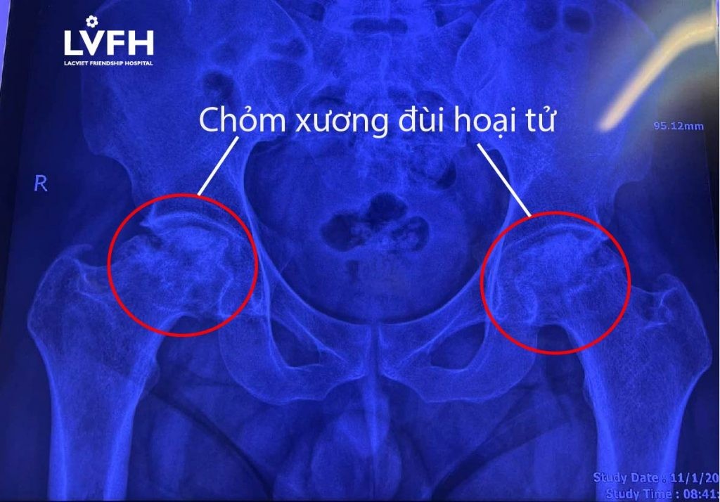 Nguy cơ mắc bệnh hoại tử vô khuẩn chỏm xương đùi ở người trẻ 1 Trước Mổ.