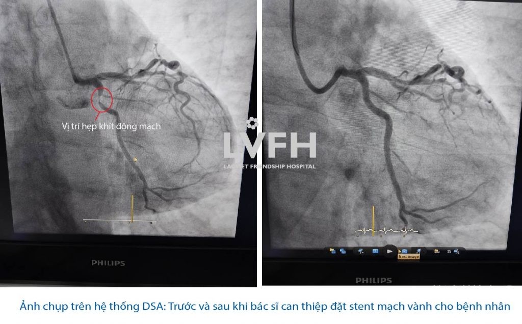 Chốt Stent 01