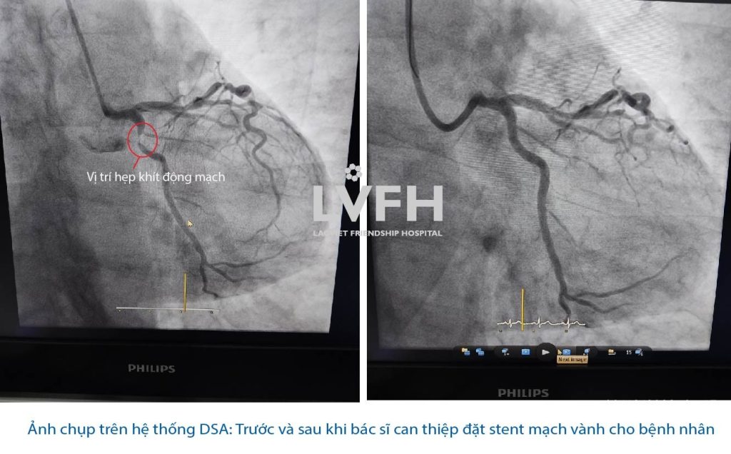 Cứu sống bệnh nhân nhồi máu cơ tim cấp trong đêm  bằng phương pháp đặt Stent động mạch vành