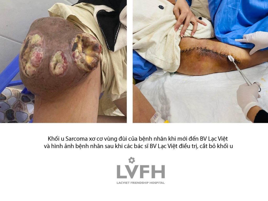Niềm vui của cô gái trẻ khi cắt bỏ được khối U 2,6 kg trên đùi  suốt 8 năm qua
