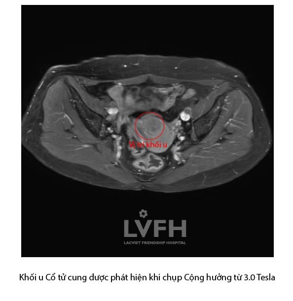 U Cổ Tc 01
