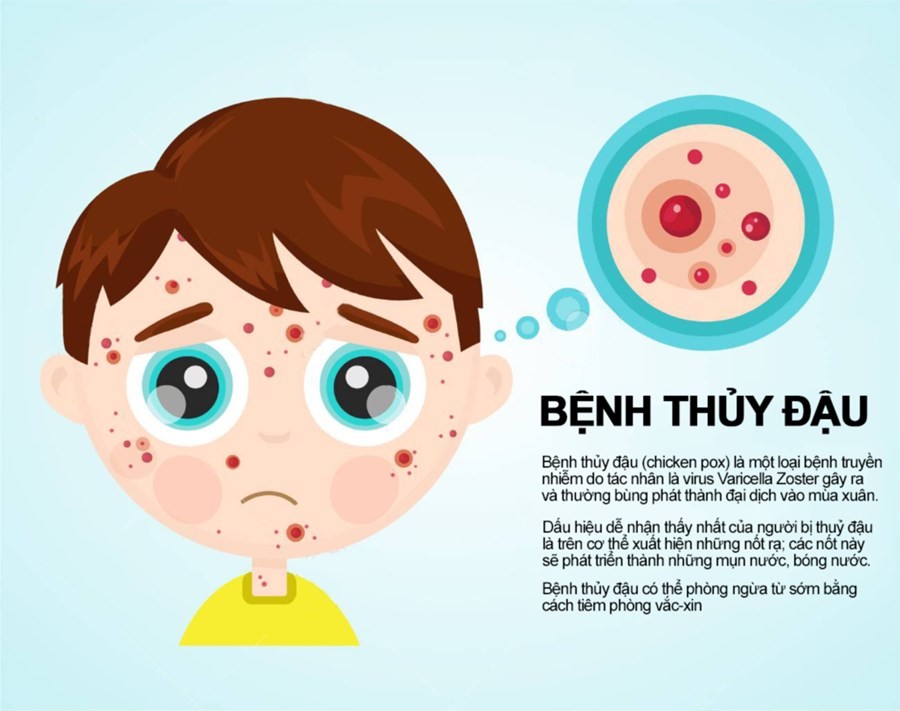 Tăng cường phòng chống bệnh Thủy đậu và những biến chứng nguy hiểm của bệnh