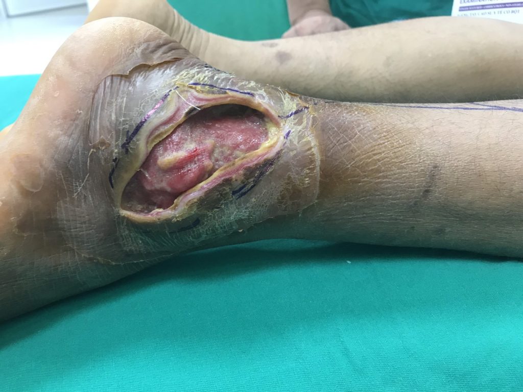 Phẫu thuật chuyển vạt da “vá” ổ áp xe lớn ở mắt cá chân