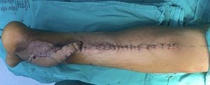 Chân bệnh nhân sau phẫu thuật chuyển vạt da