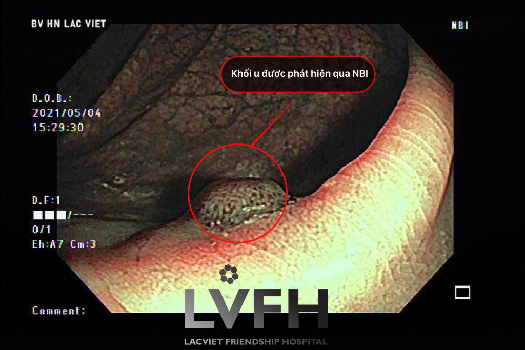 Anh Polyp 01