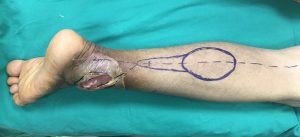 Hình ảnh sau cắt lọc sạch vết thương và thiết kế vạt sural trước mổ