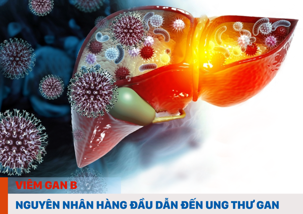 Viêm gan B – Nguyên nhân Ung thư gan hàng đầu và cách phòng ngừa