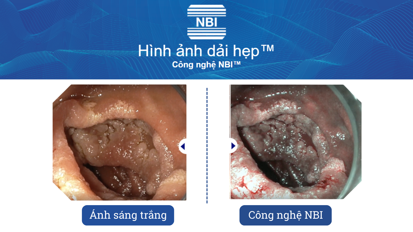 Công nghệ NBI - Công nghệ hình ảnh dải hẹp