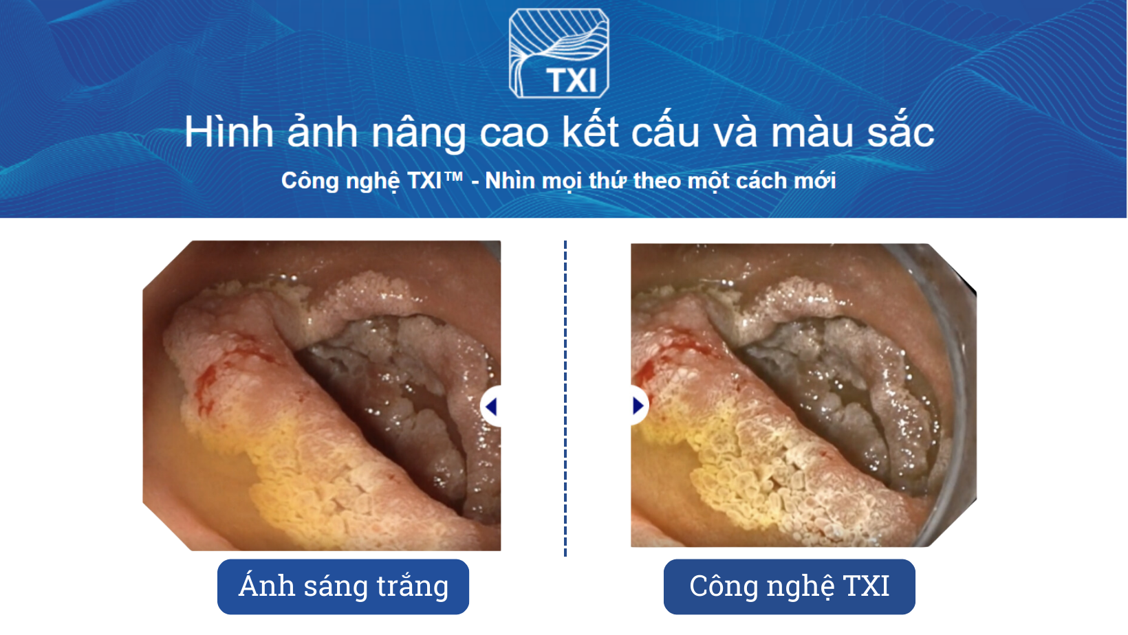 Công nghệ TXI - Ánh sáng trắng mới (Hình ảnh nâng cao kết cấu và màu sắc) 
