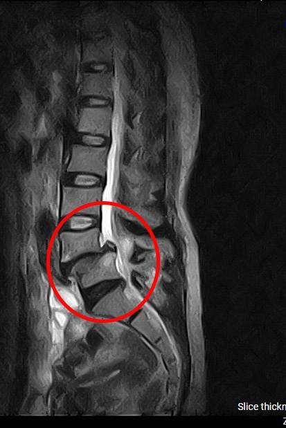 Chấm dứt đau lưng do trượt đốt sống gần 20 năm