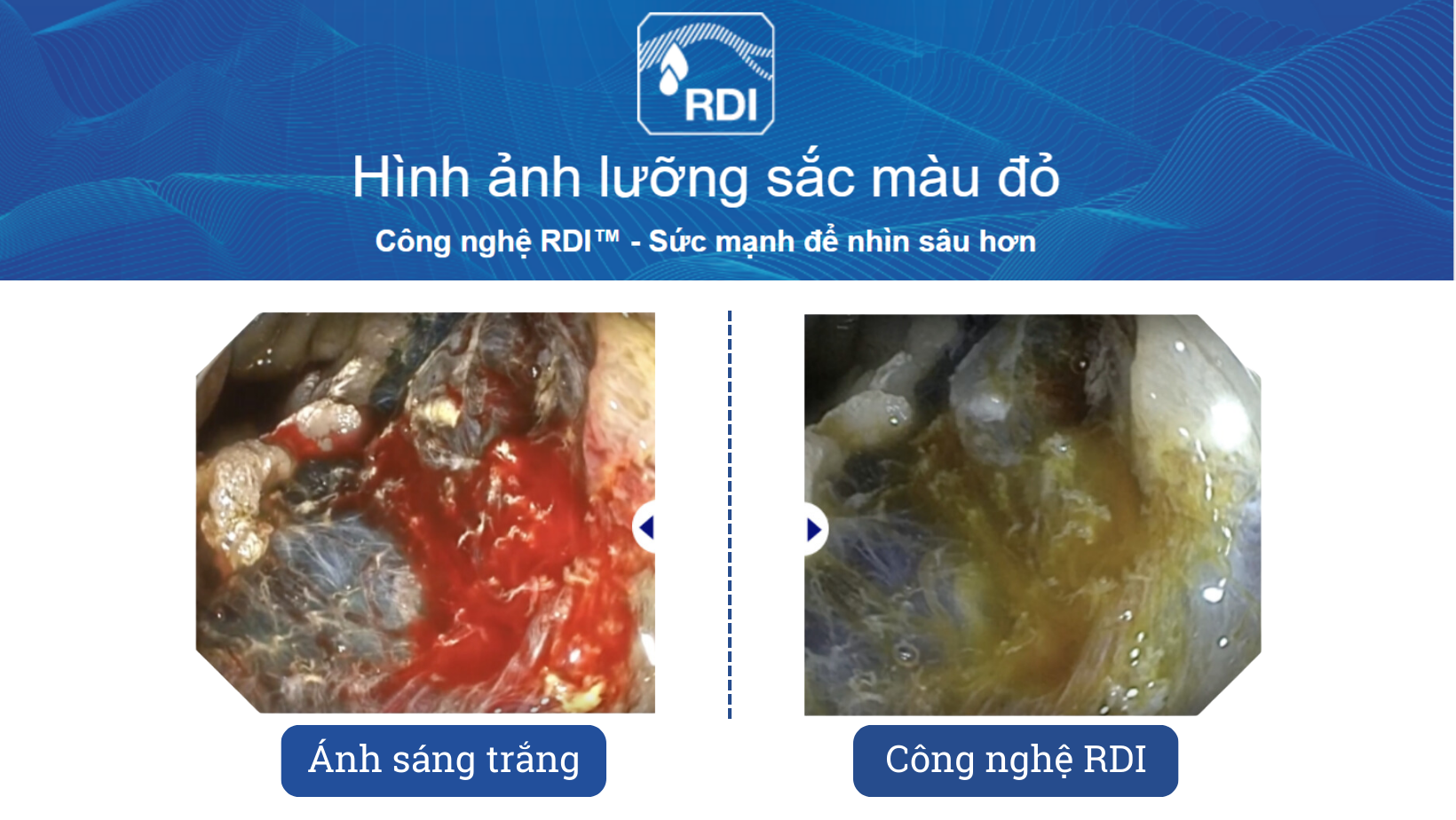Công nghệ RDI - Hình ảnh lưỡng sắc màu đỏ, giúp phát hiện các điểm chảy máu 
