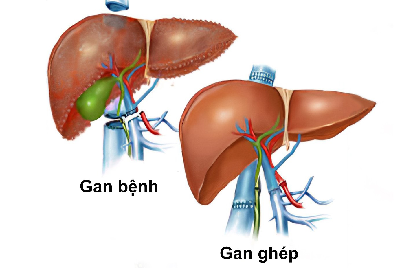 Phương pháp ghép gan