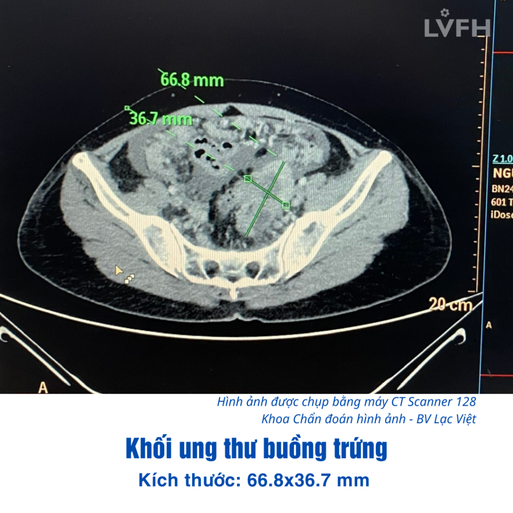 Chẩn đoán Ung thư buồng trứng di căn ở BV Lạc Việt dù đã đi khám nhiều nơi