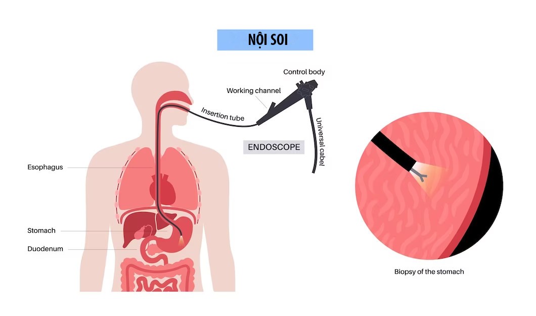 Nội soi dạ dày: Khi nào cần nội soi và những điều cần lưu ý 1 Nội soi dạ dày là phương pháp thăm khám trực tiếp nhất phần trên của ống tiêu hóa