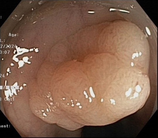 polyp kích thước lớn