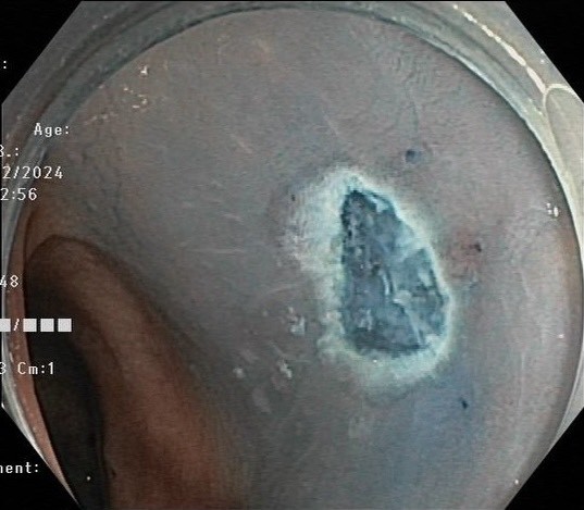 Sau khi cat Polyp