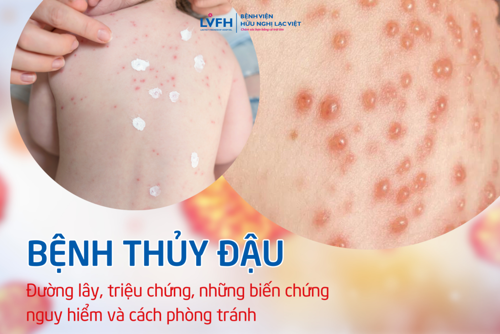 Bệnh thủy đậu: Đường lây, triệu chứng và cách phòng tránh