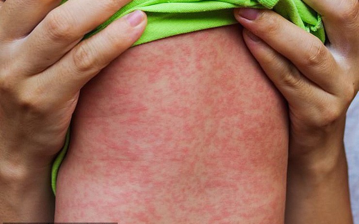 Các nốt phát ban bệnh Sởi ở trẻ nhỏ