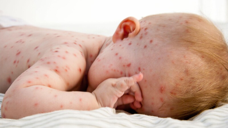 Các nốt phát ban do virus thủy đậu gây ra có khả năng lây lan rất nhanh