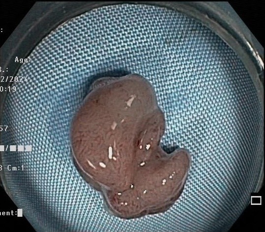polyp