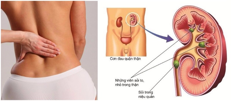 phương pháp tán sỏi ngoài cơ thể