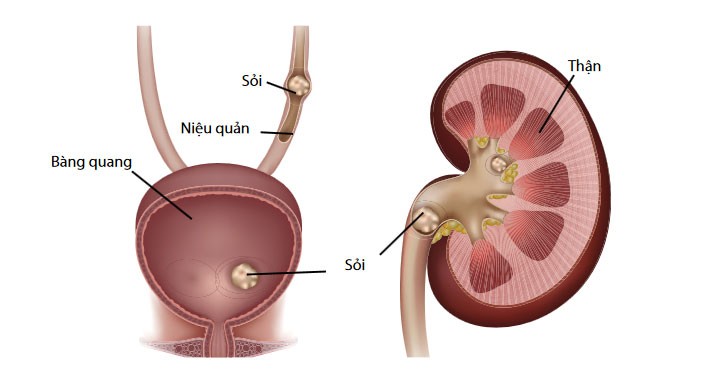 Tán sỏi thận ở bệnh viện nào tốt nhất? 1 soi than 1